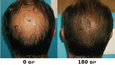תמונות לפני ואחרי הטיפול בספריי הקנאביס של אחד הנבדקים במחקר (International Journal of Trichology, 2023)